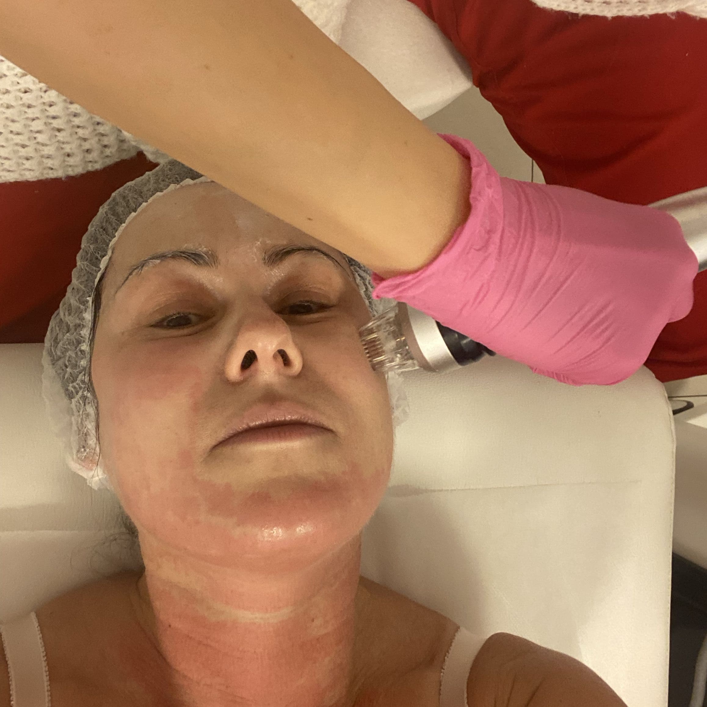 Zabieg RF frakcyjnego mikroigłowego SkinFrax na twarzy w Studiu Urody Iwona Cieślińska