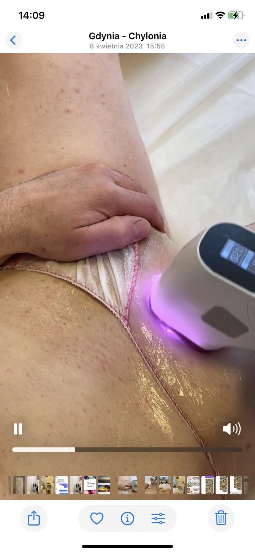 Epilacja laserowa okolic bikini