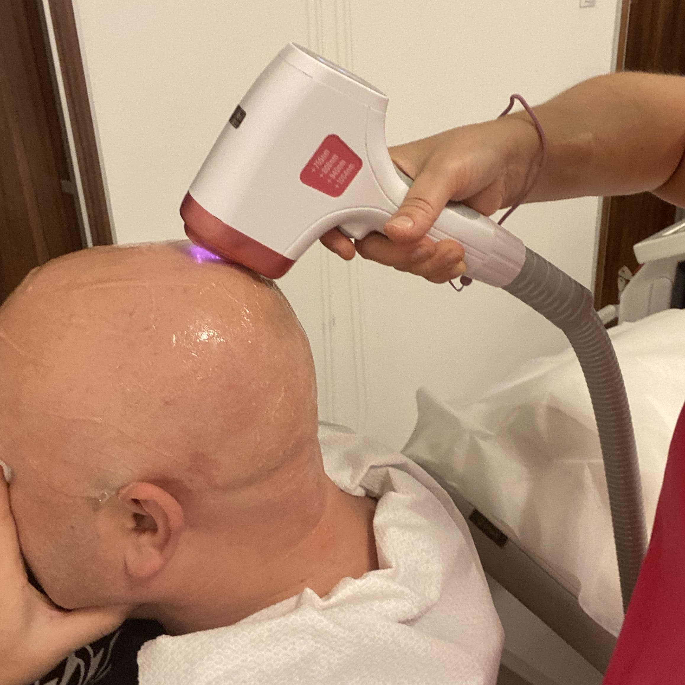 Epilacja laserowa twarzy