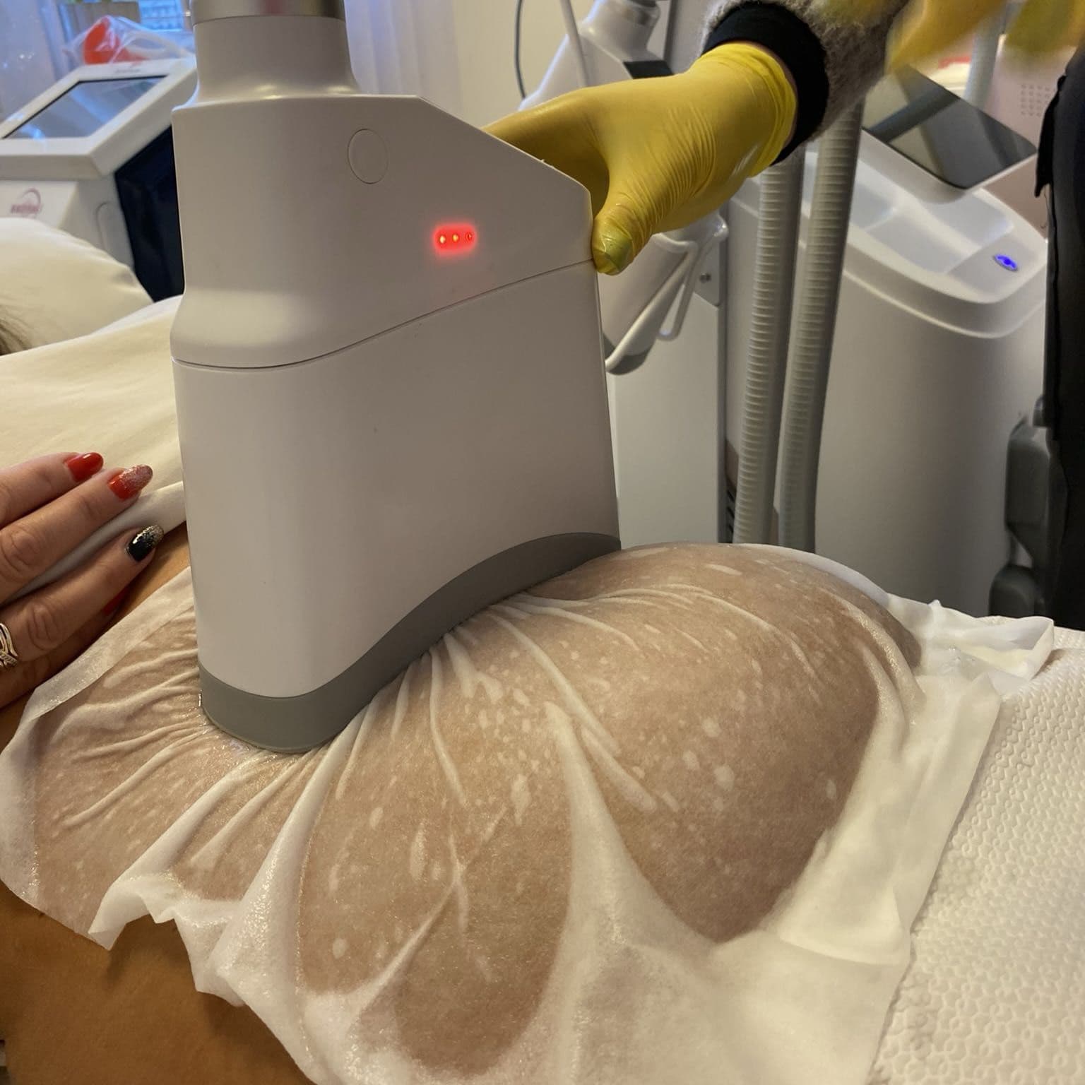 Zabieg kriolipolizy CryoCell redukujący tkankę tłuszczową
